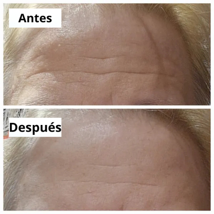 PARCHES SUAVIZANTES DE ARRUGAS - FRENTE Y OJOS